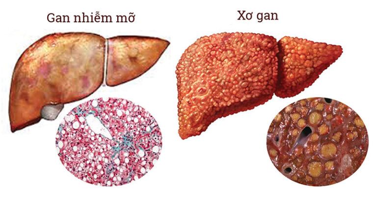 Xét nghiệm máu là phương pháp phổ biến để kiểm tra chỉ số men gan