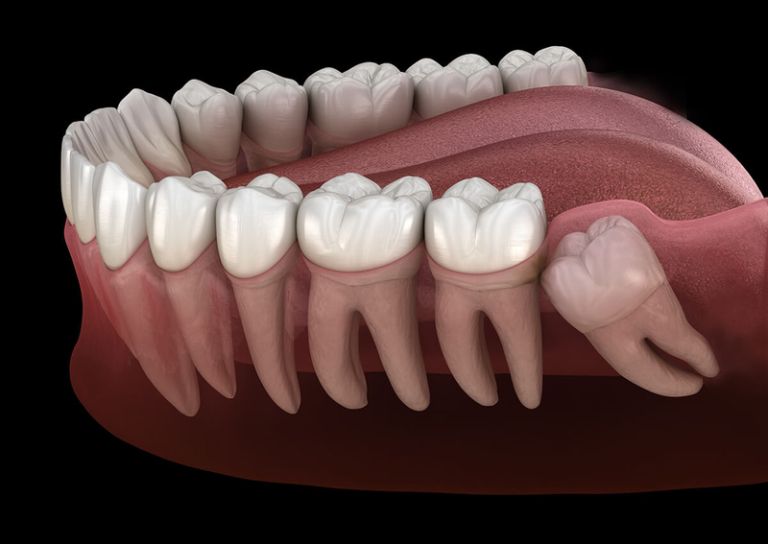 Vệ sinh răng miệng đúng cách giúp hạn chế tích tụ mảng bám và giảm nguy cơ sưng mộng răng.