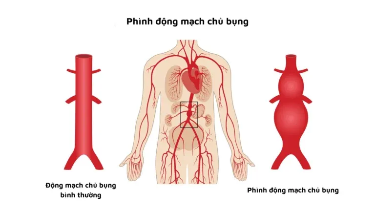Phình động mạch thân tạng có thể gây đau bụng hoặc rối loạn tiêu hóa