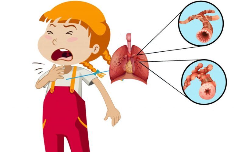 Viêm tiểu phế quản là bệnh lý hô hấp thường gặp ở trẻ nhỏ