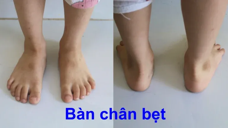 Cấu trúc xương của bàn chân bẹt hoàn toàn phẳng lì so với độ lõm tự nhiên của bàn chân bình thường